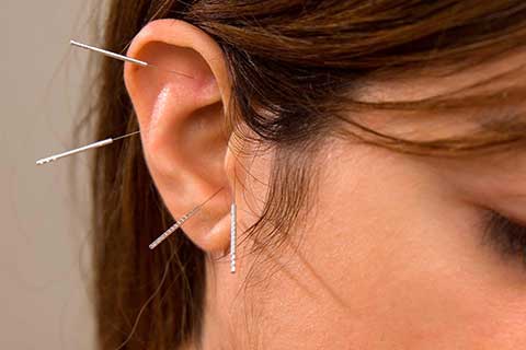 Acupuncture in the Ear